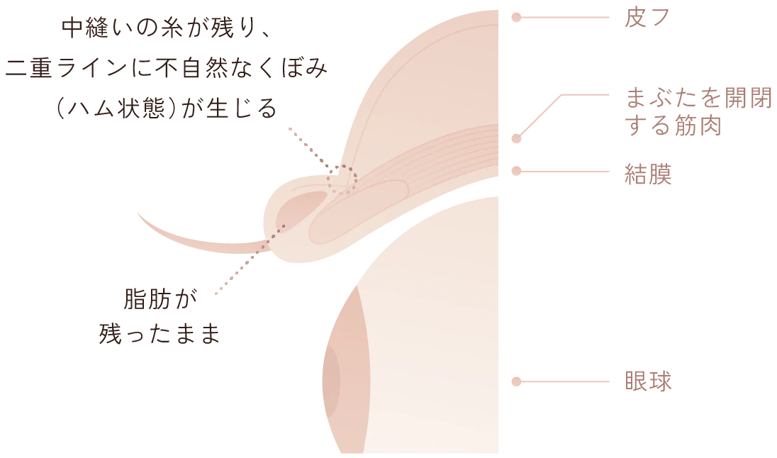 従来の切開法