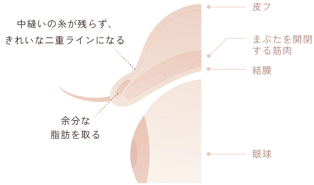 最新の切開法